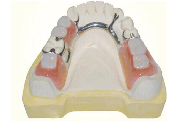 活动假牙 活动假牙