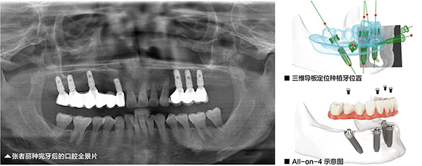 美奥口腔All-on-4种植牙案例 美奥口腔All-on-4种植牙案例