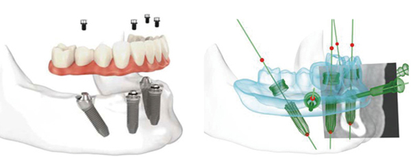 All-on-4种植牙 All-on-4种植牙