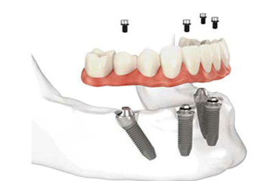 All-on-4种植牙 苏州美奥口腔 All-on-4种植牙 苏州美奥口腔