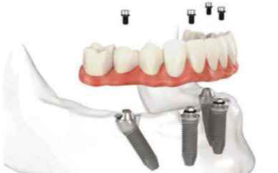 全口种植牙-苏州美奥口腔 全口种植牙-苏州美奥口腔