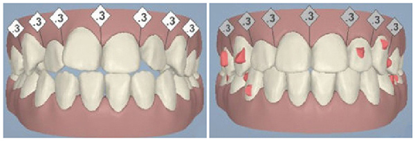 隐形牙套矫正过程 隐形牙套矫正过程