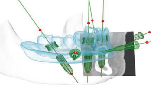 三维种植牙导板 三维种植牙导板