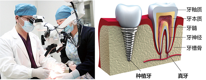 美奥智能种植牙 美奥智能种植牙